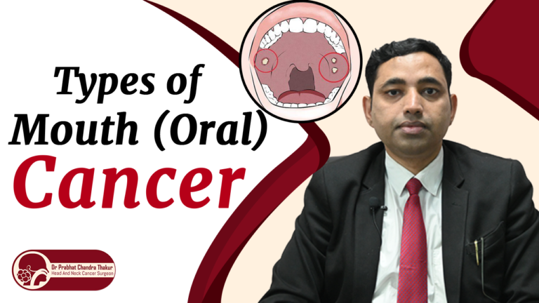 Types of mouth cancer by region by Dr. Prabhat
