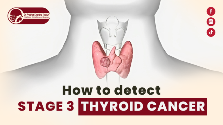 stage 3 thyroid cancer