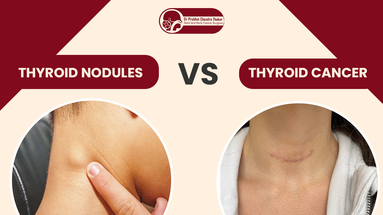 Thyroid Nodule vs Thyroid Cancer